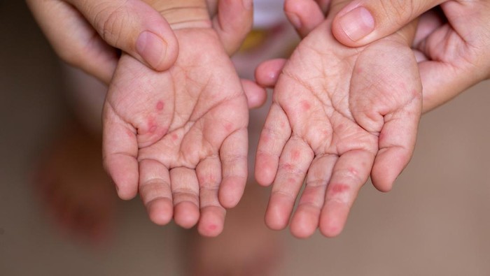 Ahli UGM Ingatkan Risiko Campak di Tengah Mobilitas Mudik